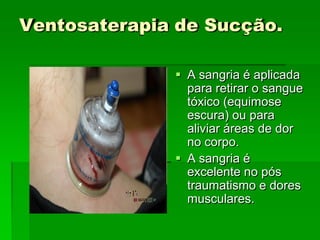Ventosaterapia de Sucção.
 A sangria é aplicada
para retirar o sangue
tóxico (equimose
escura) ou para
aliviar áreas de dor
no corpo.
 A sangria é
excelente no pós
traumatismo e dores
musculares.
 