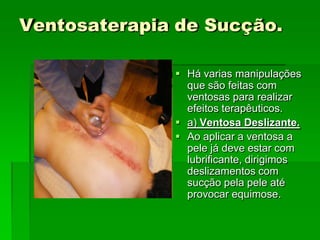 Ventosaterapia de Sucção.
 Há varias manipulações
que são feitas com
ventosas para realizar
efeitos terapêuticos.
 a) Ventosa Deslizante.
 Ao aplicar a ventosa a
pele já deve estar com
lubrificante, dirigimos
deslizamentos com
sucção pela pele até
provocar equimose.
 