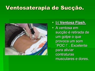 Ventosaterapia de Sucção.
 b) Ventosa Flash.
 A ventosa em
sucção é retirada de
um golpe o que
provoca um som
¨POC !¨ . Excelente
para aliviar
contraturas
musculares e dores.
 