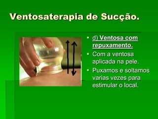 Ventosaterapia de Sucção.
 d) Ventosa com
repuxamento.
 Com a ventosa
aplicada na pele.
 Puxamos e soltamos
varias vezes para
estimular o local.
 