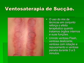 Ventosaterapia de Sucção.
 O uso do mix de
técnicas em conjunto
reforça o efeito
terapêutico quando
tratamos órgãos internos
e suas funções.
 Unindo ventosa Flash,
ventosa deslizante,
ventosa com rotação e
repuxamento e ventosa
parada durante 3 a 5
minutos.
 