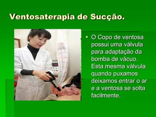Ventosaterapia de Sucção.
 O Copo de ventosa
possui uma válvula
para adaptação da
bomba de vácuo.
Esta mesma válvula
quando puxamos
deixamos entrar o ar
e a ventosa se solta
facilmente.
 