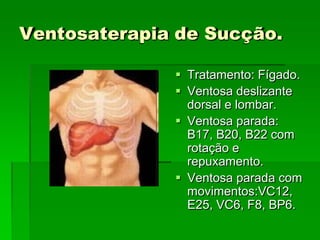 Ventosaterapia de Sucção.
 Tratamento: Fígado.
 Ventosa deslizante
dorsal e lombar.
 Ventosa parada:
B17, B20, B22 com
rotação e
repuxamento.
 Ventosa parada com
movimentos:VC12,
E25, VC6, F8, BP6.
 