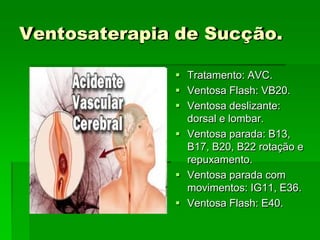Ventosaterapia de Sucção.
 Tratamento: AVC.
 Ventosa Flash: VB20.
 Ventosa deslizante:
dorsal e lombar.
 Ventosa parada: B13,
B17, B20, B22 rotação e
repuxamento.
 Ventosa parada com
movimentos: IG11, E36.
 Ventosa Flash: E40.
 