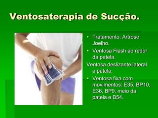 Ventosaterapia de Sucção.
 Tratamento: Artrose
Joelho.
 Ventosa Flash ao redor
da patela.
Ventosa deslizante lateral
a patela.
 Ventosa fixa com
movimentos: E35, BP10,
E36, BP9, meio da
patela e B54.
 