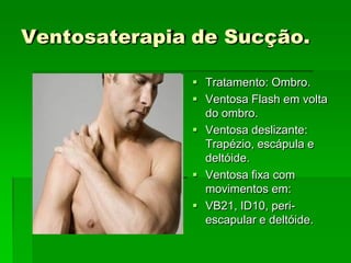Ventosaterapia de Sucção.
 Tratamento: Ombro.
 Ventosa Flash em volta
do ombro.
 Ventosa deslizante:
Trapézio, escápula e
deltóide.
 Ventosa fixa com
movimentos em:
 VB21, ID10, peri-
escapular e deltóide.
 
