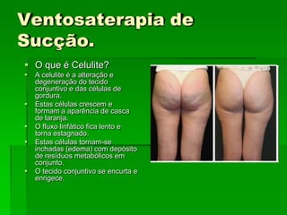 Ventosaterapia de
Sucção.
 O que é Celulite?
 A celulite é a alteração e
degeneração do tecido
conjuntivo e das células de
gordura.
 Estas células crescem e
formam a aparência de casca
de laranja.
 O fluxo linfático fica lento e
torna estagnado.
 Estas células tornam-se
inchadas (edema) com depósito
de resíduos metabólicos em
conjunto.
 O tecido conjuntivo se encurta e
enrigece.
 