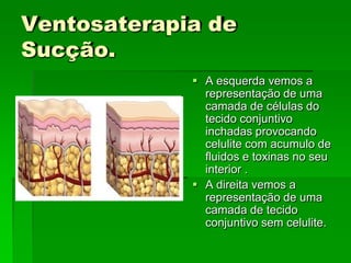Ventosaterapia de
Sucção.
 A esquerda vemos a
representação de uma
camada de células do
tecido conjuntivo
inchadas provocando
celulite com acumulo de
fluidos e toxinas no seu
interior .
 A direita vemos a
representação de uma
camada de tecido
conjuntivo sem celulite.
 