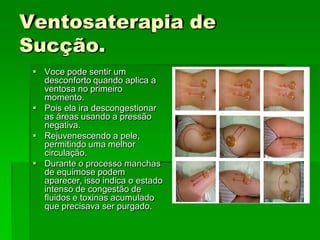 Ventosaterapia de
Sucção.
 Voce pode sentir um
desconforto quando aplica a
ventosa no primeiro
momento.
 Pois ela ira descongestionar
as áreas usando a pressão
negativa.
 Rejuvenescendo a pele,
permitindo uma melhor
circulação.
 Durante o processo manchas
de equimose podem
aparecer, isso indica o estado
intenso de congestão de
fluidos e toxinas acumulado
que precisava ser purgado.
 