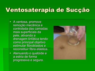 Ventosaterapia de Sucção
 A ventosa, promove
remoção mecânica e
controlada das camadas
mais superficiais da
pele, ativando a
drenagem linfática tendo
como principal objetivo
estimular fibroblastos e
reconstituir fibra elástica.
 Atenuando o quelóide e
a estria de forma
progressiva e segura.
 