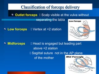 Classification of forceps deliveryClassification of forceps delivery
Outlet forceps  Scalp visible at the vulva without
separating the labia
Low forceps  Vertex at +2 station
Midforceps  Head is engaged but leading part
above +2 station
 Sagittal suture not in the AP plane
of the mother
 