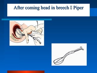 After coming head in breechAfter coming head in breech  PiperPiper
 