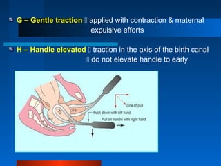 G – Gentle traction  applied with contraction & maternal
expulsive efforts
H – Handle elevated  traction in the axis of the birth canal
 do not elevate handle to early
 