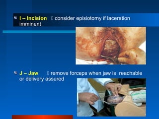 I – Incision  consider episiotomy if laceration
imminent
J – Jaw  remove forceps when jaw is reachable
or delivery assured
 