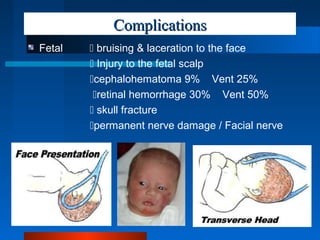 ComplicationsComplications
Fetal  bruising & laceration to the face
 Injury to the fetal scalp
cephalohematoma 9% Vent 25%
retinal hemorrhage 30% Vent 50%
 skull fracture
permanent nerve damage / Facial nerve
 