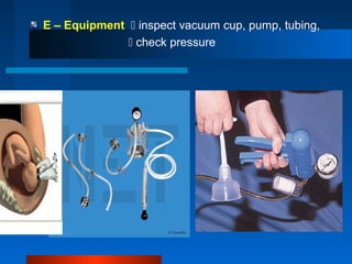 E – Equipment  inspect vacuum cup, pump, tubing,
 check pressure
 