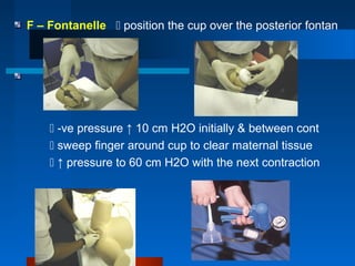 F – Fontanelle  position the cup over the posterior fontan
 -ve pressure ↑ 10 cm H2O initially & between cont
 sweep finger around cup to clear maternal tissue
 ↑ pressure to 60 cm H2O with the next contraction
 