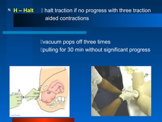 H – Halt  halt traction if no progress with three traction
aided contractions
vacuum pops off three times
pulling for 30 min without significant progress
 