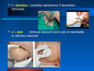 I – Incision consider episiotomy if laceration
imminent
J – Jaw remove vacuum when jaw is reachable
or delivery assured
 
