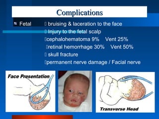 ComplicationsComplications
Fetal  bruising & laceration to the face
 Injury to the fetal scalp
cephalohematoma 9% Vent ...