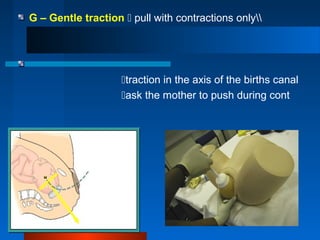 G – Gentle traction  pull with contractions only
traction in the axis of the births canal
ask the mother to push during...
