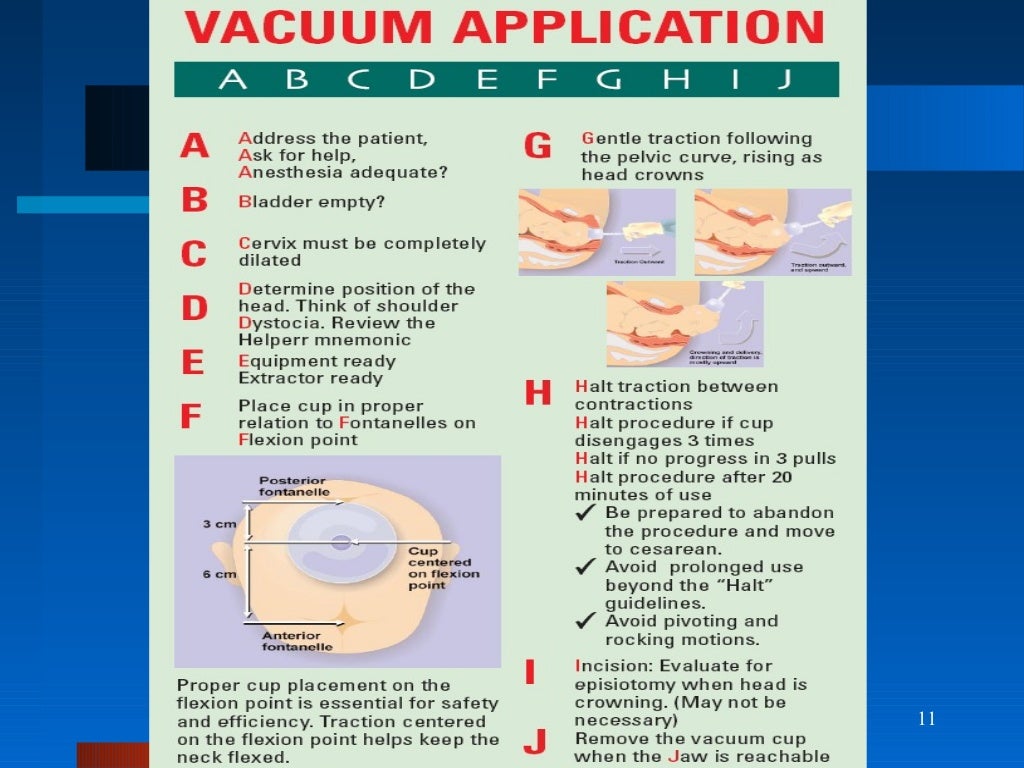 Ventose And Forceps Delivery For Undergraduate
