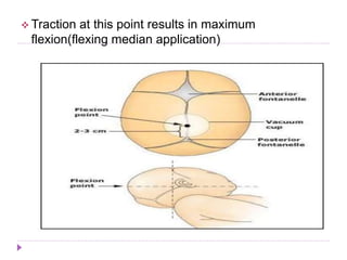  Traction at this point results in maximum
flexion(flexing median application)
 