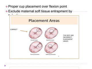  Proper cup placement over flexion point
 Exclude maternal soft tissue entrapment by
palpation
 