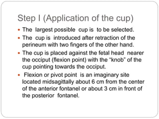 Step I (Application of the cup)
 The largest possible cup is to be selected.
 The cup is introduced after retraction of the
perineum with two fingers of the other hand.
 The cup is placed against the fetal head nearer
the occiput (flexion point) with the “knob” of the
cup pointing towards the occiput.
 Flexion or pivot point is an imaginary site
located midsagittally about 6 cm from the center
of the anterior fontanel or about 3 cm in front of
the posterior fontanel.
 