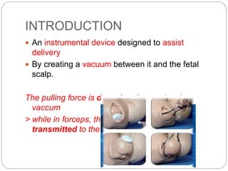 INTRODUCTION
 An instrumental device designed to assist
delivery
 By creating a vacuum between it and the fetal
scalp.
The pulling force is dragging the cranium in
vaccum
> while in forceps, the pulling force is directly
transmitted to the base of the skull
 