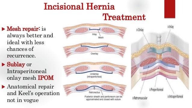 Incisional Hernia Repair
