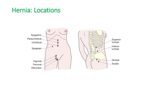Hernia: Locations
 