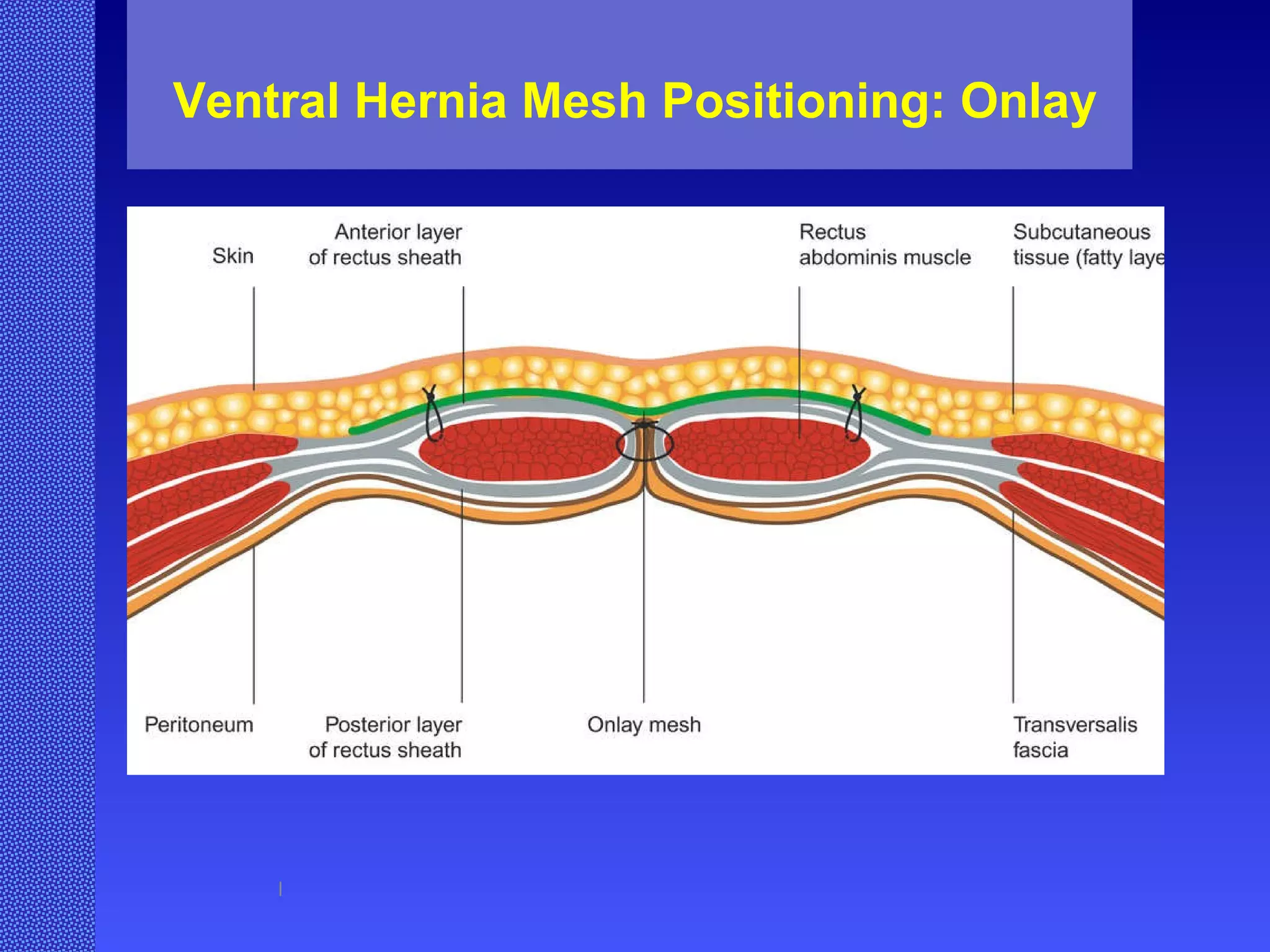 Ventral Hernia Mesh Positioning: Onlay l 