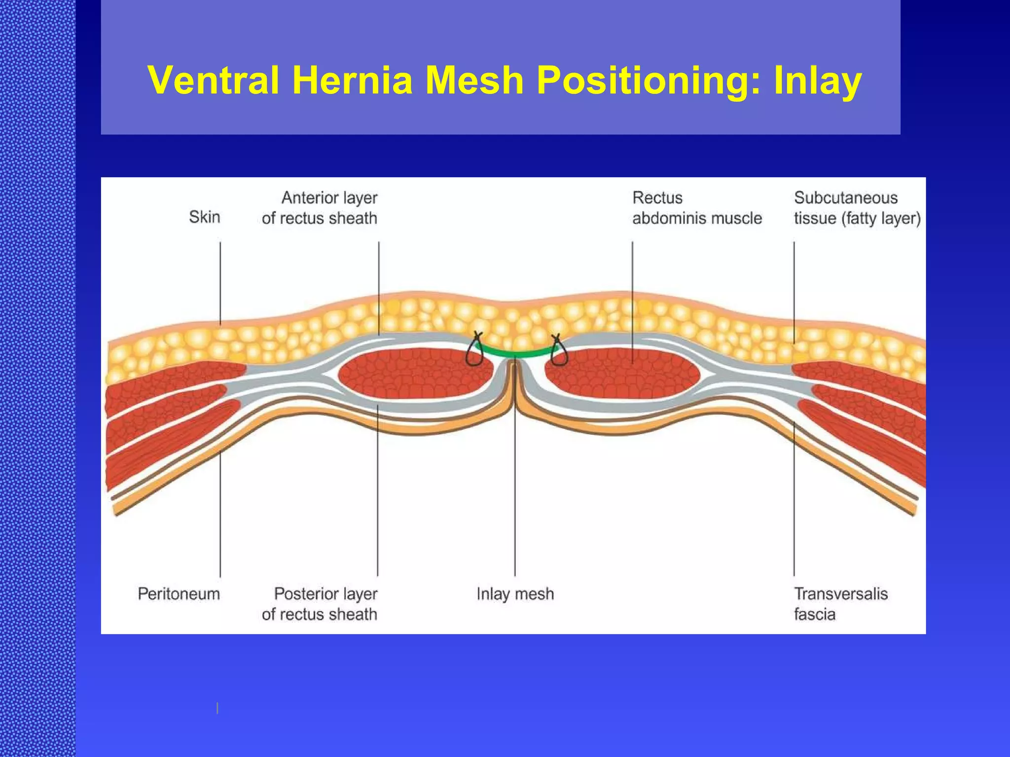 Ventral Hernia Mesh Positioning: Inlay l 