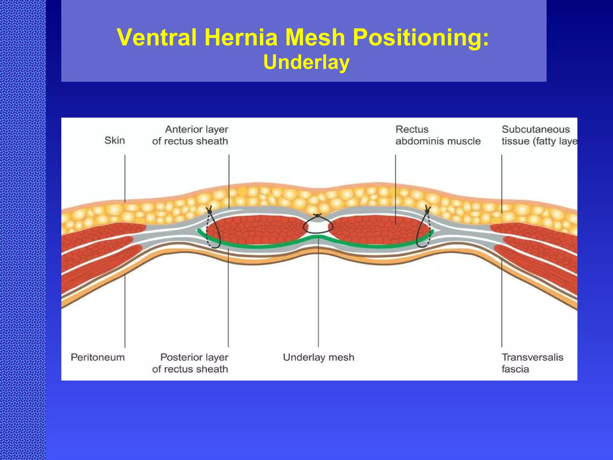 Ventral Hernia Mesh Positioning:  Underlay 