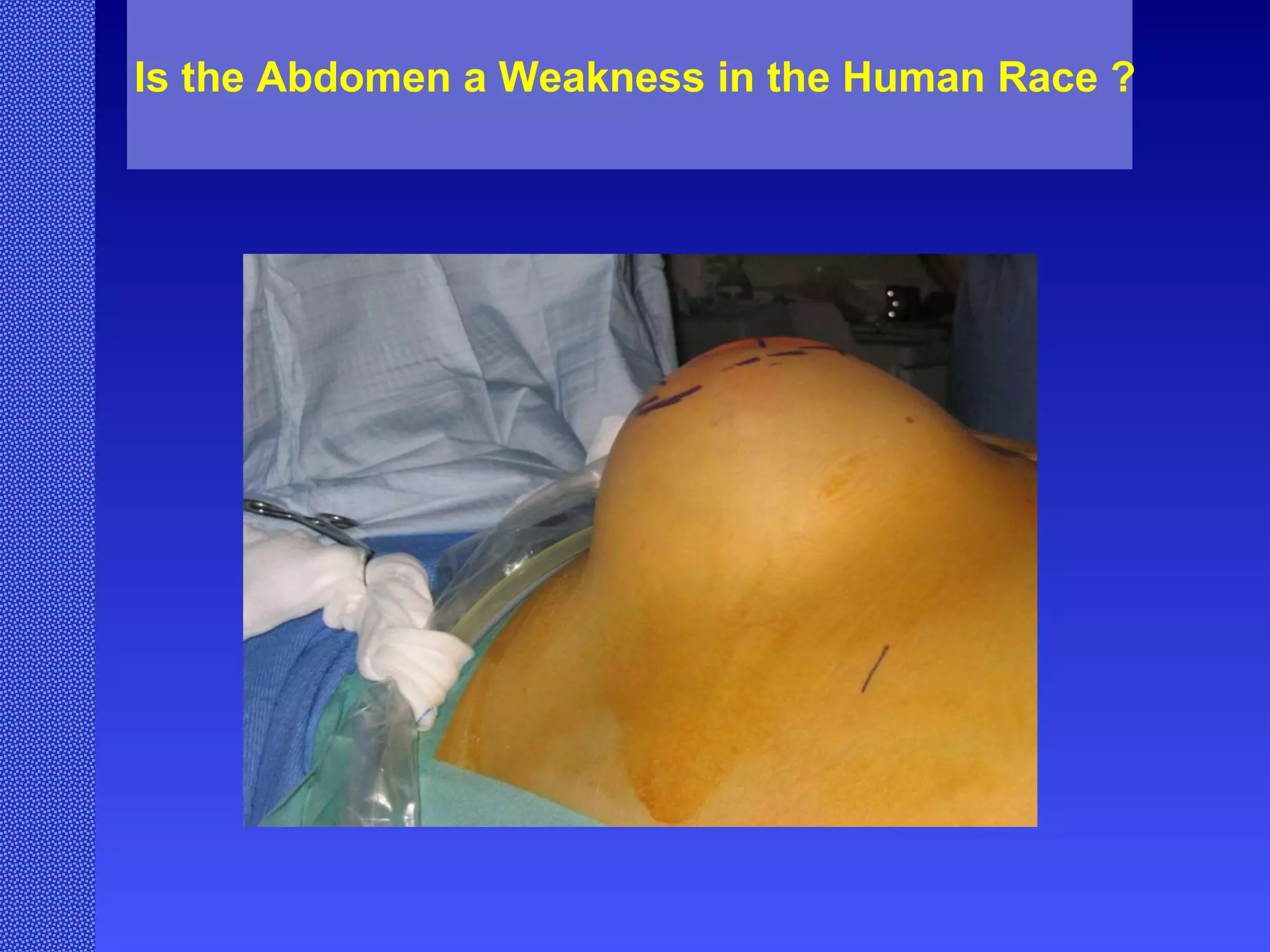 Is the Abdomen a Weakness in the Human Race ? 