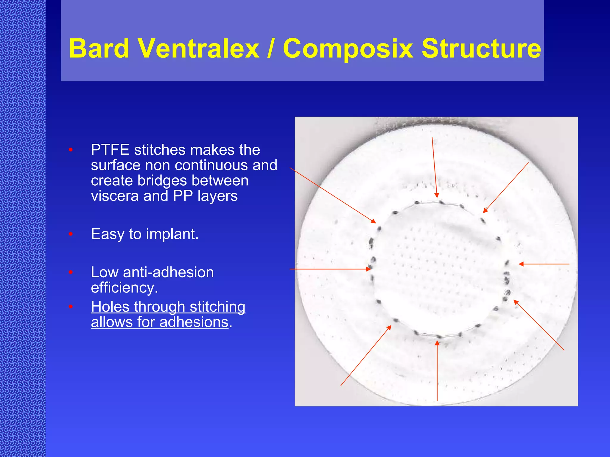 Bard Ventralex / Composix Structure PTFE stitches makes the surface non continuous and create bridges between viscera and PP layers Easy to implant. Low anti-adhesion efficiency. Holes through stitching allows for adhesions . 
