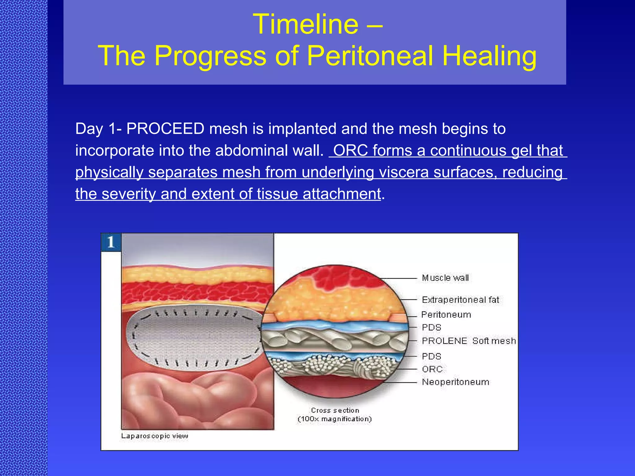 Timeline – The Progress of Peritoneal Healing Day 1- PROCEED mesh is implanted and the mesh begins to  incorporate into the abdominal wall.  ORC forms a continuous gel that  physically separates mesh from underlying viscera surfaces, reducing  the severity and extent of tissue attachment .  