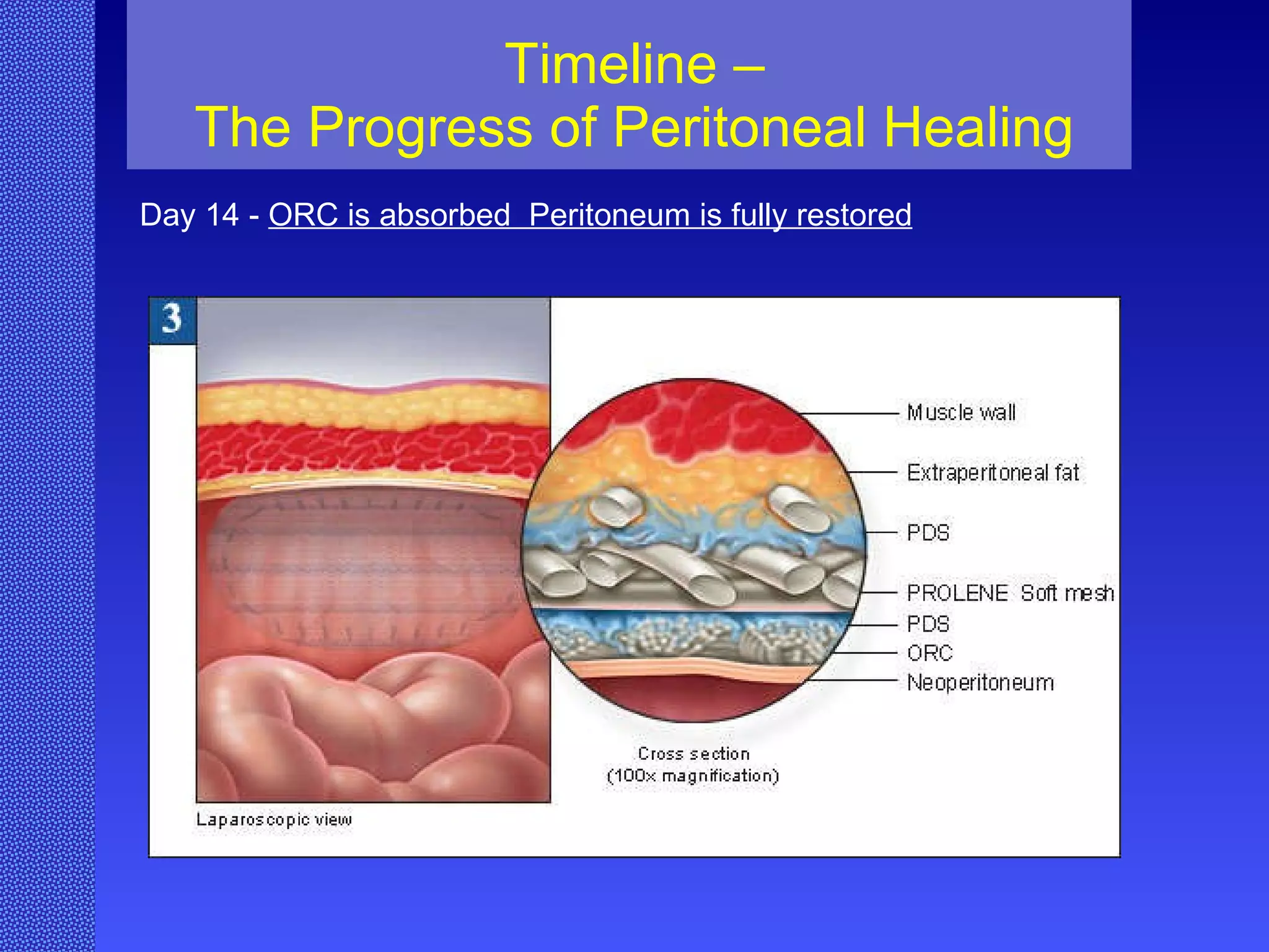 Timeline – The Progress of Peritoneal Healing Day 14 -  ORC is absorbed  Peritoneum is fully restored 