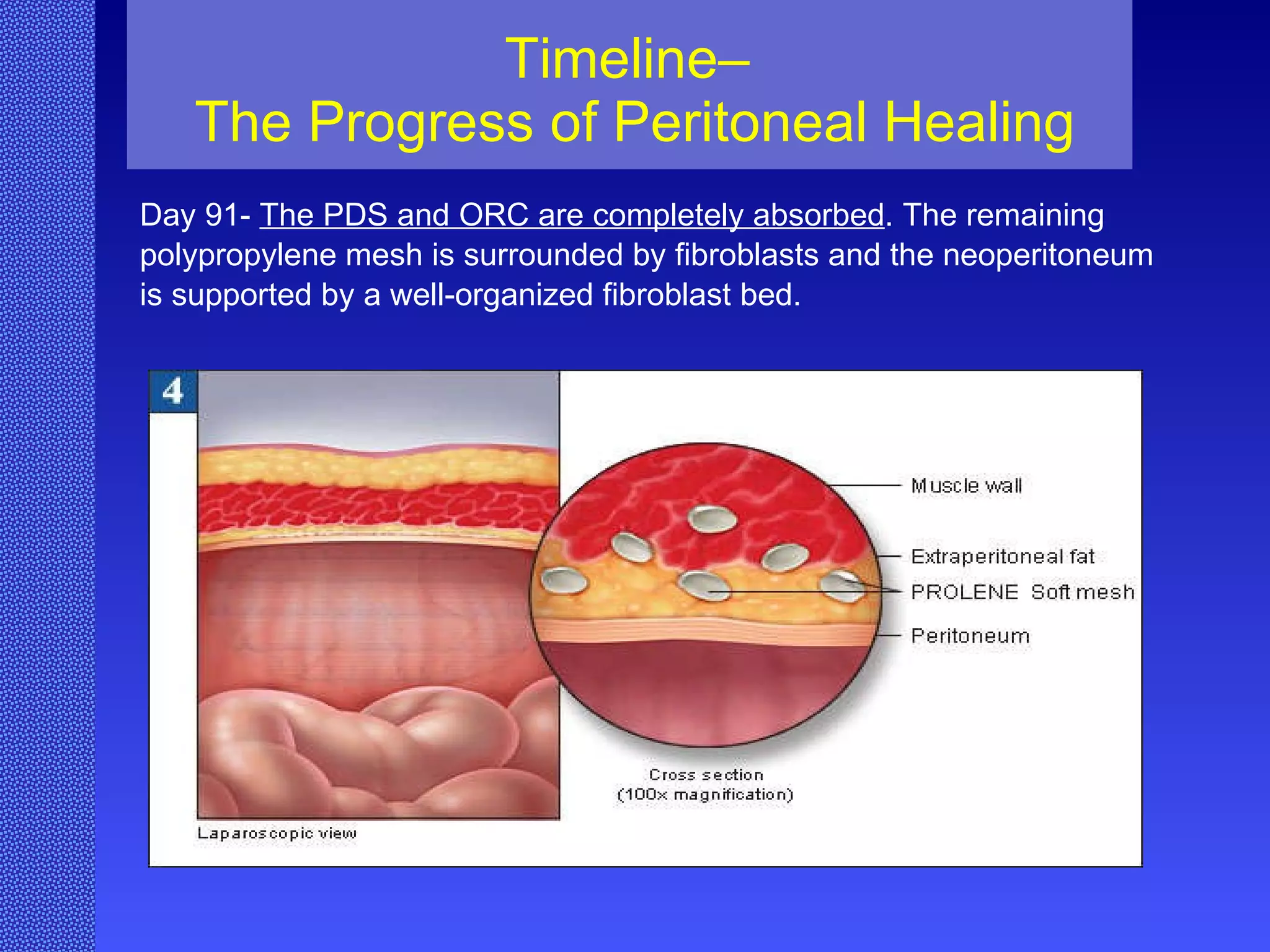 Timeline–  The Progress of Peritoneal Healing Day 91-  The PDS and ORC are completely absorbed . The remaining polypropylene mesh is surrounded by fibroblasts and the neoperitoneum  is supported by a well-organized fibroblast bed. 
