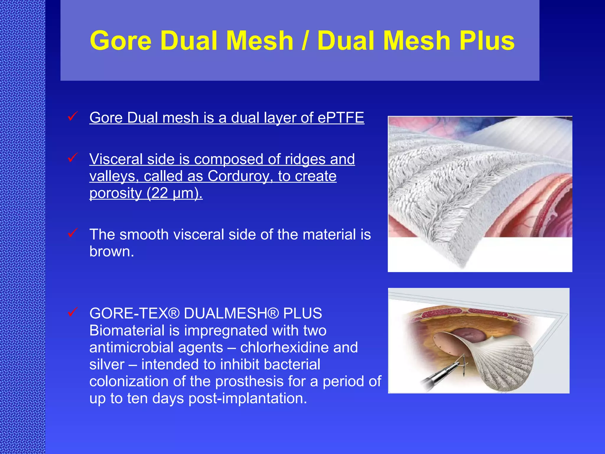 Gore Dual Mesh / Dual Mesh Plus Gore Dual mesh is a dual layer of ePTFE Visceral side is composed of ridges and valleys, called as Corduroy, to create porosity (22 µm). The smooth visceral side of the material is brown. GORE-TEX® DUALMESH® PLUS Biomaterial is impregnated with two antimicrobial agents – chlorhexidine and silver – intended to inhibit bacterial colonization of the prosthesis for a period of up to ten days post-implantation. 