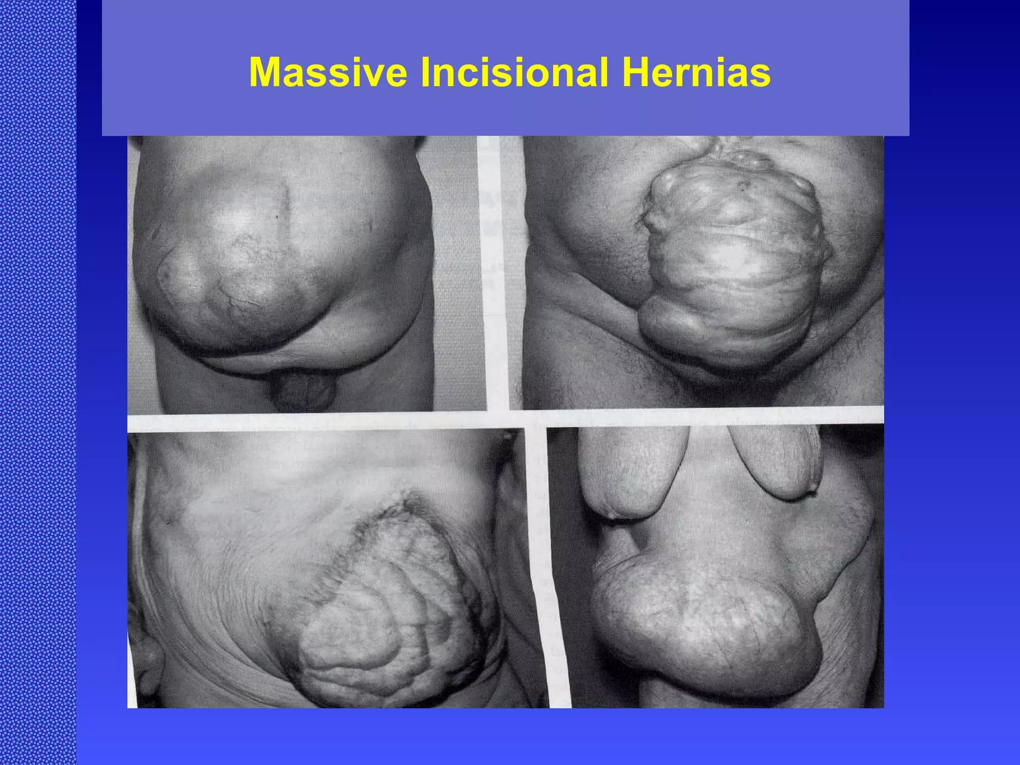 Massive Incisional Hernias 
