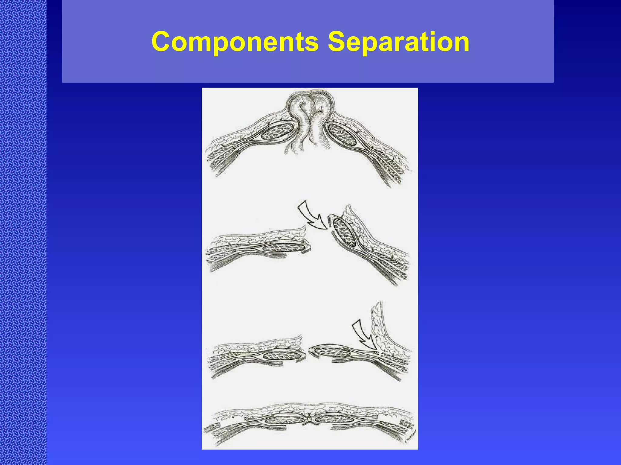 Components Separation 