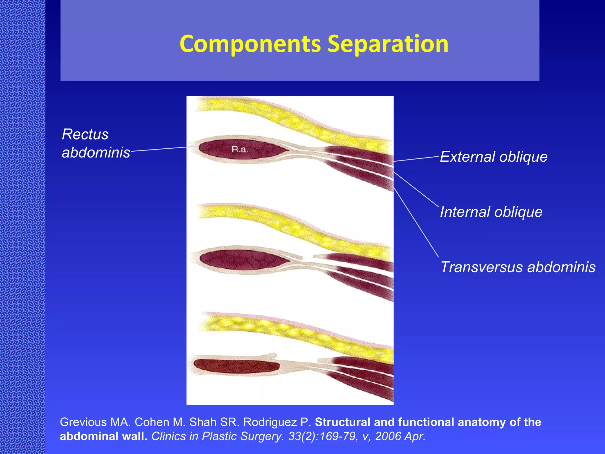 Grevious MA. Cohen M. Shah SR. Rodriguez P.  Structural and functional anatomy of the abdominal wall.   Clinics in Plastic Surgery. 33(2):169-79, v, 2006 Apr. External oblique Internal oblique Transversus abdominis Rectus abdominis Components Separation 