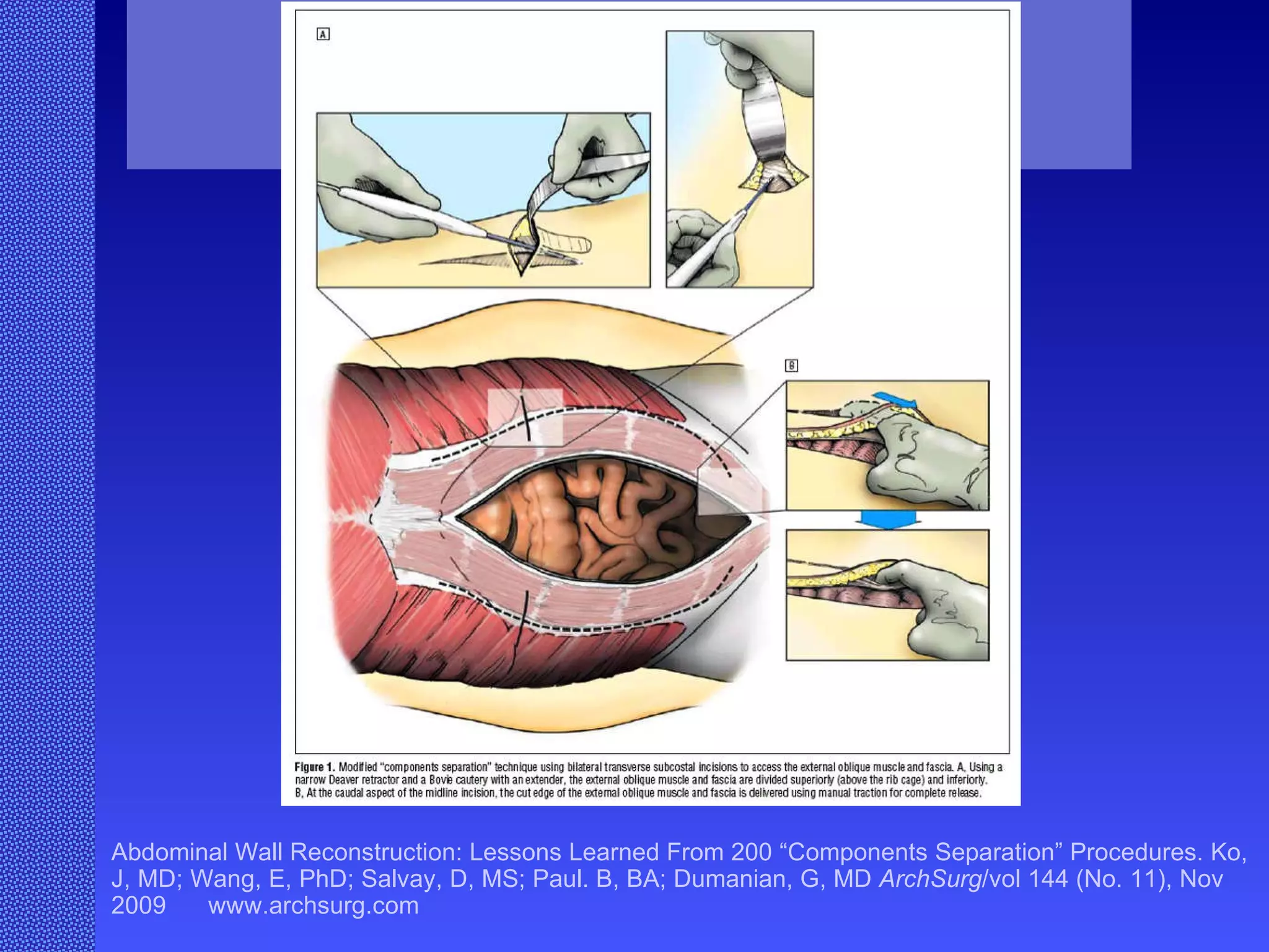 Abdominal Wall Reconstruction: Lessons Learned From 200 “Components Separation” Procedures. Ko, J, MD; Wang, E, PhD; Salvay, D, MS; Paul. B, BA; Dumanian, G, MD  ArchSurg /vol 144 (No. 11), Nov 2009  www.archsurg.com Figure 1. Modified “components separation” technique using bilateral transverse subcostal incisions to access the external oblique muscle and fascia . A, Using a narrow Deaver retractor and a Bovie cautery with and extender, the external oblique muscle and fascia are divided superiorly (above the rib cage) and inferiorly. B, At the caudal aspect of the midline incision, the cut edge of the external oblique muscle and fascia is delivered using manual traction for complete release. 