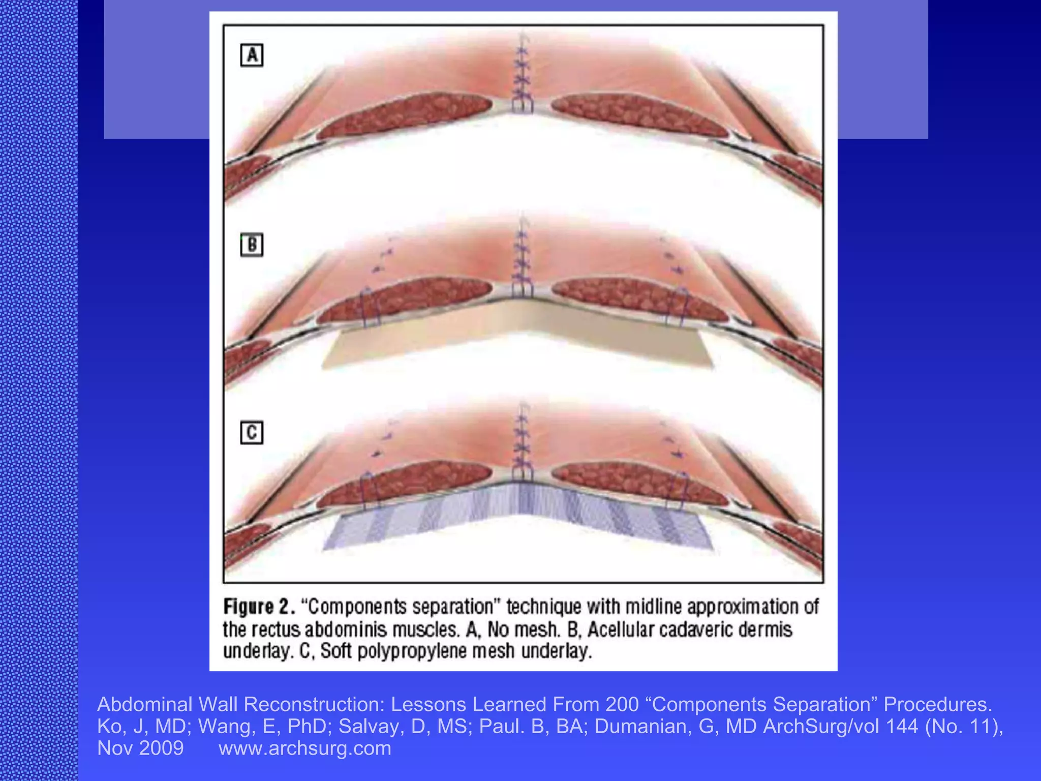 Abdominal Wall Reconstruction: Lessons Learned From 200 “Components Separation” Procedures. Ko, J, MD; Wang, E, PhD; Salvay, D, MS; Paul. B, BA; Dumanian, G, MD ArchSurg/vol 144 (No. 11), Nov 2009  www.archsurg.com Figure 2 “Components separation” technique with midline approximation of the rectus abdominus muscles. A, No mesh. B, Acellular cadaveric dermis underlay. C, Soft polypropylene mesh underlay.  