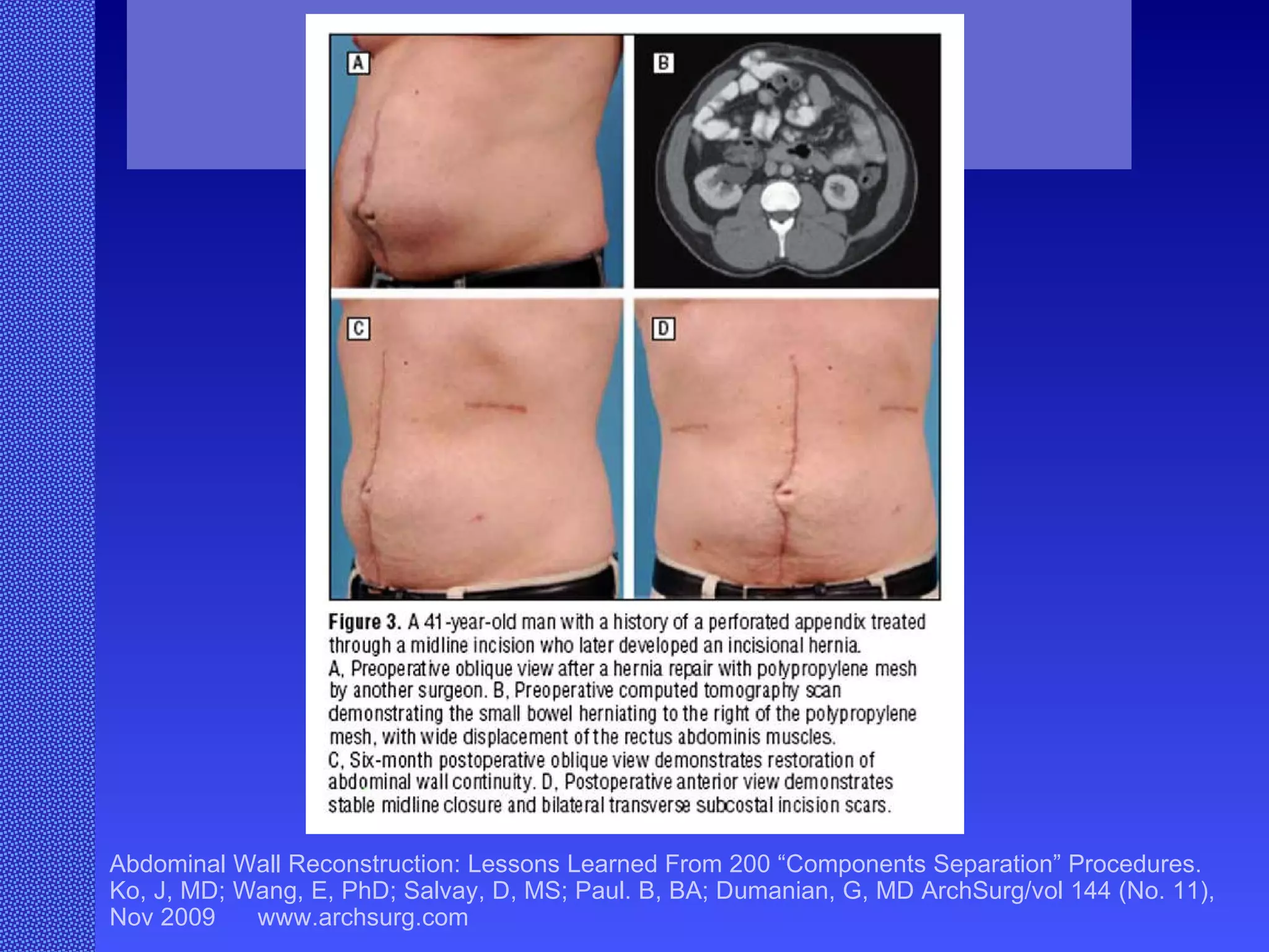 Abdominal Wall Reconstruction: Lessons Learned From 200 “Components Separation” Procedures. Ko, J, MD; Wang, E, PhD; Salvay, D, MS; Paul. B, BA; Dumanian, G, MD ArchSurg/vol 144 (No. 11), Nov 2009  www.archsurg.com Figure 3 A 41-year old man with a history of a perforated appendix treated through a midline incision who later developed an incisional hernia. A, Preoperative oblique view after a hernia repair with polypropylene mesh by another surgeon. B, Preoperative computed tomography scan demonstrating the small bowel herniating to the right of the polypropylene mesh, with wide displacement of the rectus abdominus muscles. C, Six-month postoperative oblique view demonstrates restoration of abdominal wall continuity. D, Postoperative anterior view demonstates stable midline closure and bilateral transverse subcostal incision scars.  