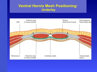 Ventral Hernia Mesh Positioning:  Underlay 