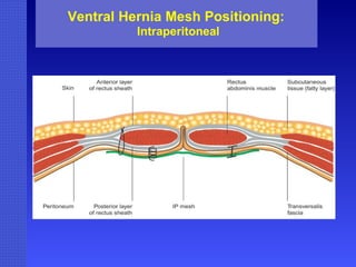 Ventral Hernia Mesh Positioning:   Intraperitoneal 