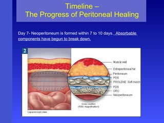 Timeline – The Progress of Peritoneal Healing Day 7- Neoperitoneum is formed within 7 to 10 days.   Absorbable  components have begun to break down. 